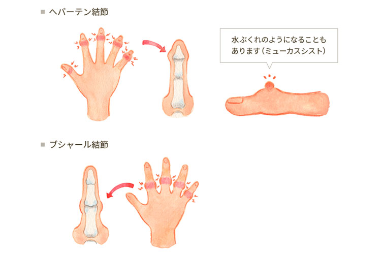手指の変形と疼痛について